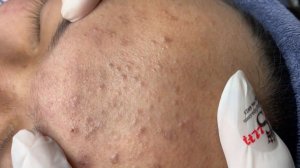 346 • Acne collection • АСМР • Relax Spa
