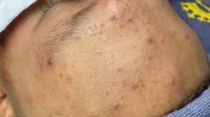 329 • Acne collection • АСМР • Relax Spa