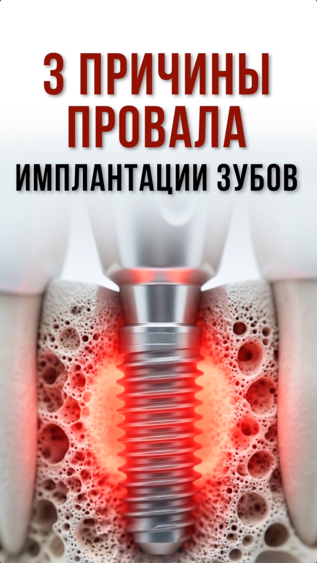 Отторжение импланта: 3 главные причины неудачной имплантации. Почему скрежетание зубами опасно
