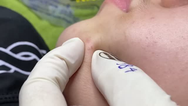 Глубокая чистка кожи от прыщей #чисткакожи #удалениепрыщей