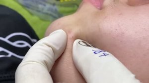 Глубокая чистка кожи от прыщей #чисткакожи #удалениепрыщей