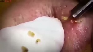 #1025 Чистка лица от угрей и акне. Выдавливание прыщей. Удаление черных точек и комедонов