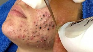 Черные точки удалены в Sac Dep Spa