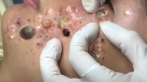 Экстремальное удаление черных точек: расслабляющее видео