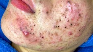 Удаление черных точек в Sac Dep Spa