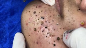 Экстремальное удаление черных точек: релакс и удовлетворение