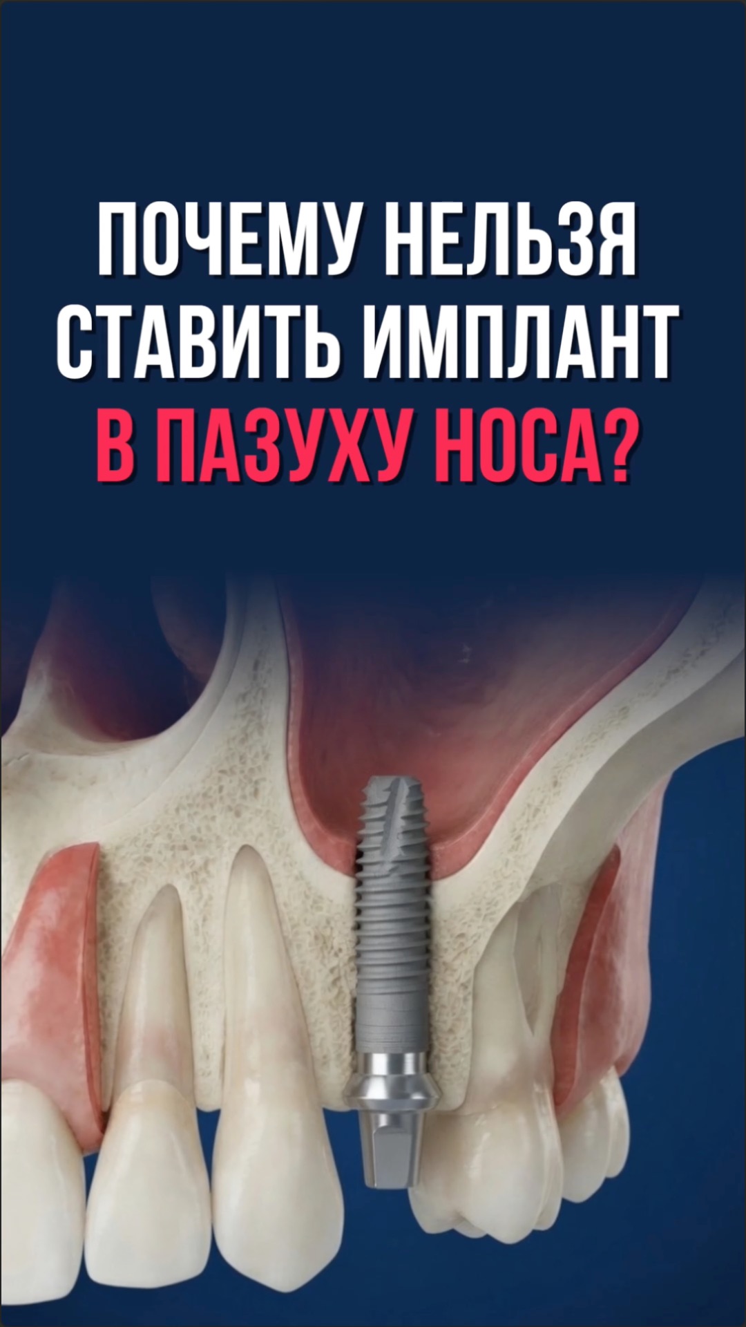 Синус-лифтинг: зачем наращивать кость перед установкой импланта. Разница открытого, закрытого метода