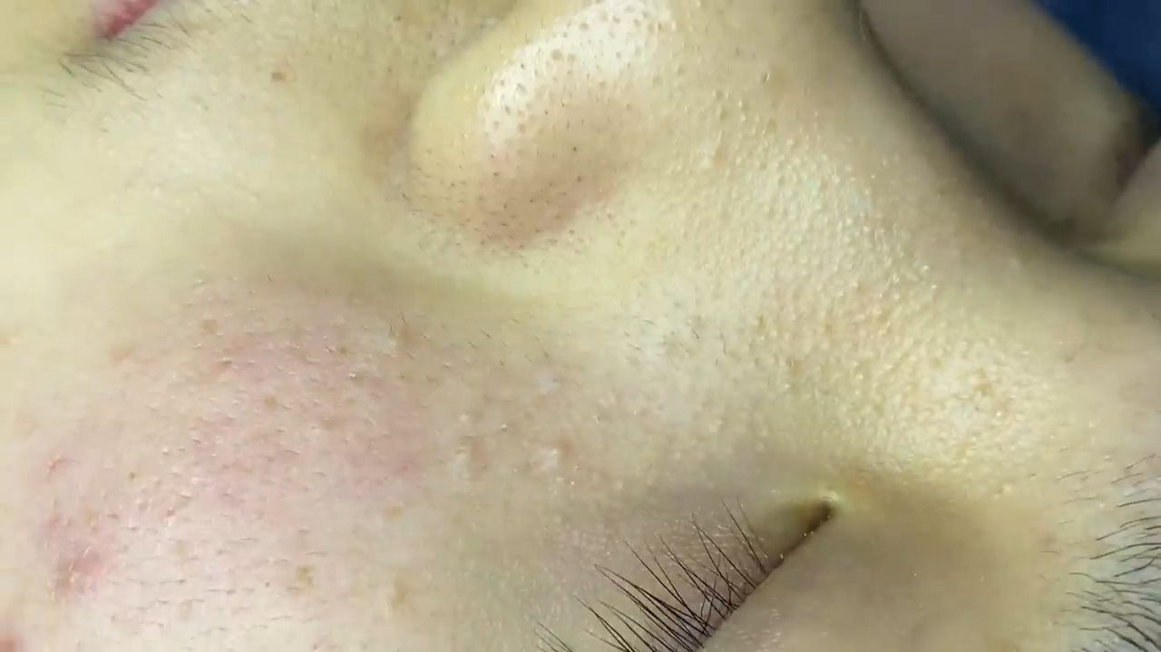 Acne Collection • A027 • Архив SacDepSpa • АСМР