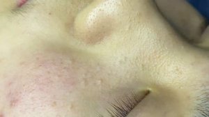 Acne collection • A027 • Архив SacDepSpa • АСМР