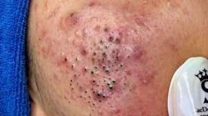 Удаление черных точек в Sac Dep Spa