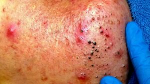 Удаление черных точек в Sac Dep Spa