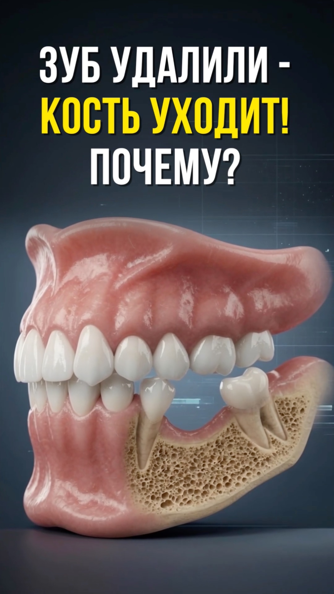 Атрофия костной ткани после удаления зуба: почему исчезает кость. Как проходит резорбция.