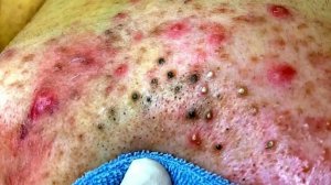 Извлечение черных точек в Sac Dep Spa