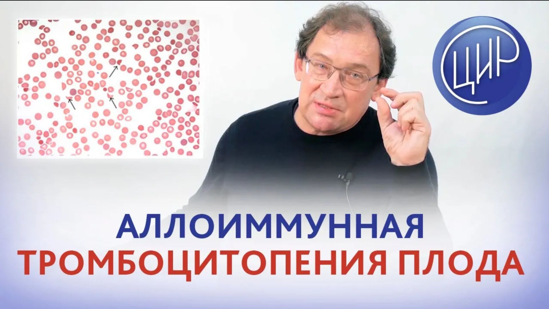 Гены ITGА2 и ITGB3, группы крови тромбоцитов и аллоиммунная тромбоцитопения плода. И.И. Гузов