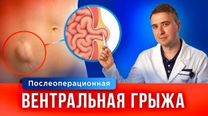 Грыжа живота: причины, симптомы, лечение, бесплатная операция по ОМС при вентральных грыжах