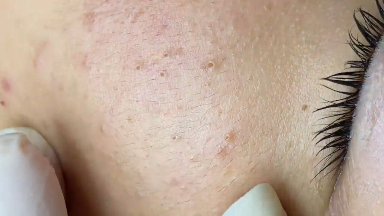 344 • Acne Collection • АСМР • Relax Spa