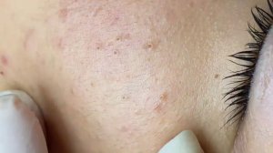 344 • Acne collection • АСМР • Relax Spa