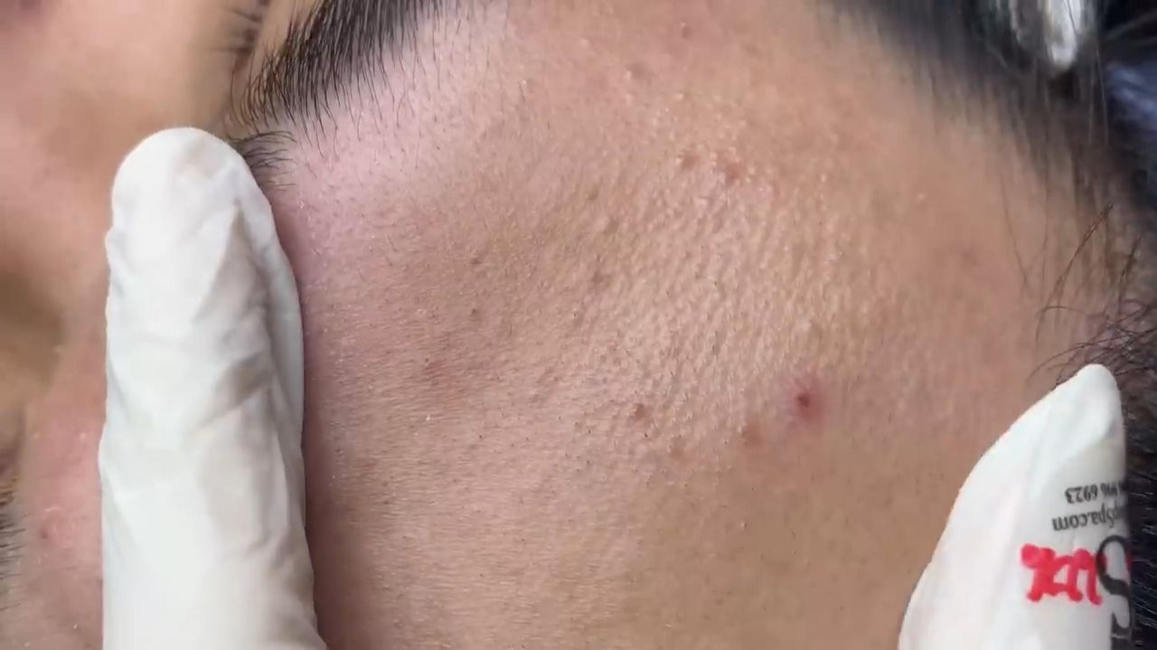 335 • Acne Collection • АСМР • Relax Spa