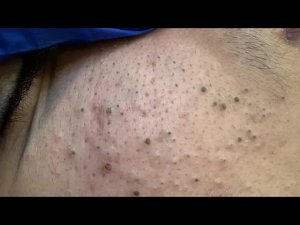 Уход за жирной кожей: удаление глубоких черных точек