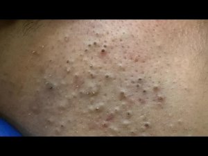 Глубокое очищение пор — удаление черных точек корейским уходом за кожей
