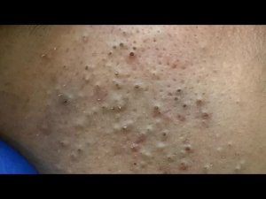 Глубокая очистка лица от прыщей и черных точек
