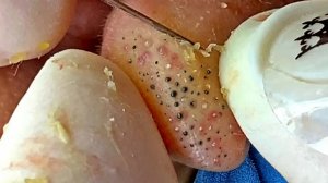 Удаление черных точек в Sac Dep Spa
