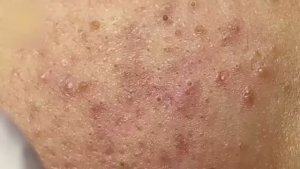 Профессиональное очищение кожи от закрытых комедонов