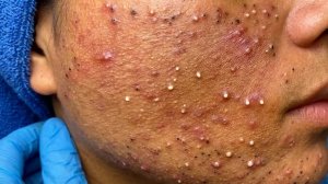 Удаление черных точек в Sac Dep Spa