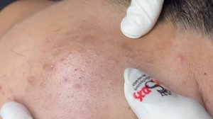 334 • Acne collection • АСМР • Relax Spa