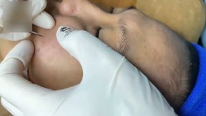Глубокая чистка кожи от прыщей и комедонов.