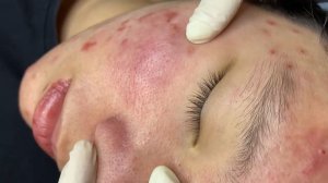 345 • Acne collection • АСМР • Relax Spa