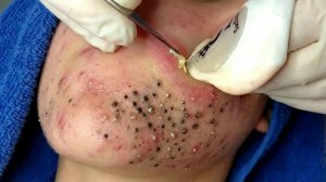 Удаление черных точек в Sac Dep Spa