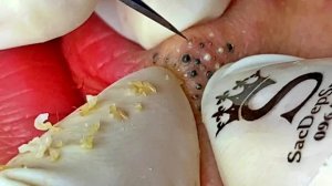Удаление черных точек в Sac Dep Spa
