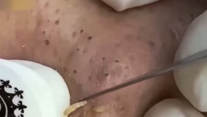 Механическая чистка кожи от комедонов