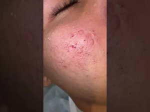 Глубокое удаление черных точек
