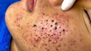 Удаление черных точек в Sac Dep Spa
