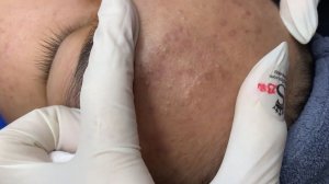 351 • Acne collection • АСМР • Relax Spa