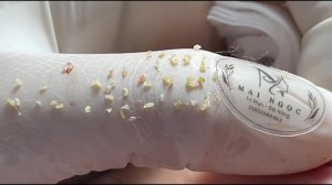 Лечение акне в домашних условиях - Май Нгок 💕💕💕