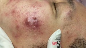 350 • Acne collection • АСМР • Relax Spa