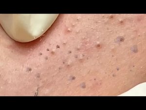 Плотное извлечение черных точек | Глубокая чистка пор – Spa Linh Mun