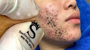 Удаление черных точек в Sac Dep Spa @480