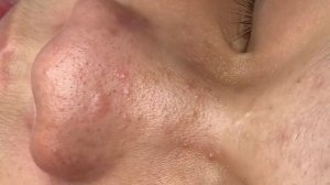 354 • Acne collection • АСМР • Relax Spa