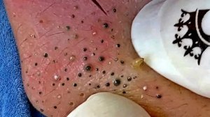 Blackhead Removal With Today Spa #2311