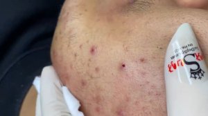 Acne collection • A030 • Архив SacDepSpa • АСМР