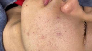 355 • Acne collection • АСМР • Relax Spa