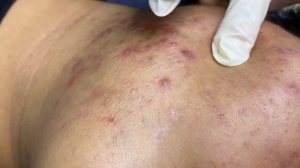 356 • Acne collection • АСМР • Relax Spa