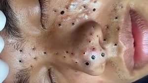 Удаление черных точек Отличное качество