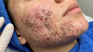 Blackhead Removal With Sac Dep Spa @481