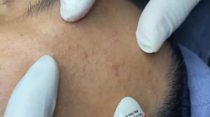 Acne collection • A029 • Архив SacDepSpa • АСМР