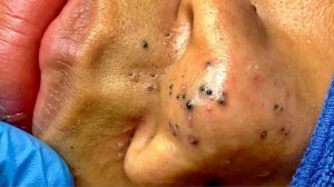 Blackhead Removal With Sac Dep Spa @901